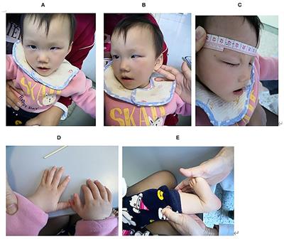 Case Report: A de novo CTNNB1 Nonsense Mutation Associated With Neurodevelopmental Disorder, Retinal Detachment, Polydactyly